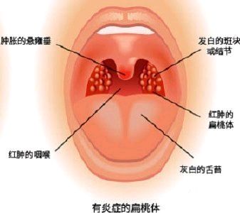 那么有人就有疑问了:既然它属于免疫器官,为什么我的扁桃体只是老