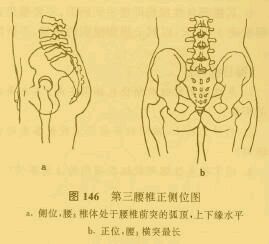 第三腰椎横突综合征.doc