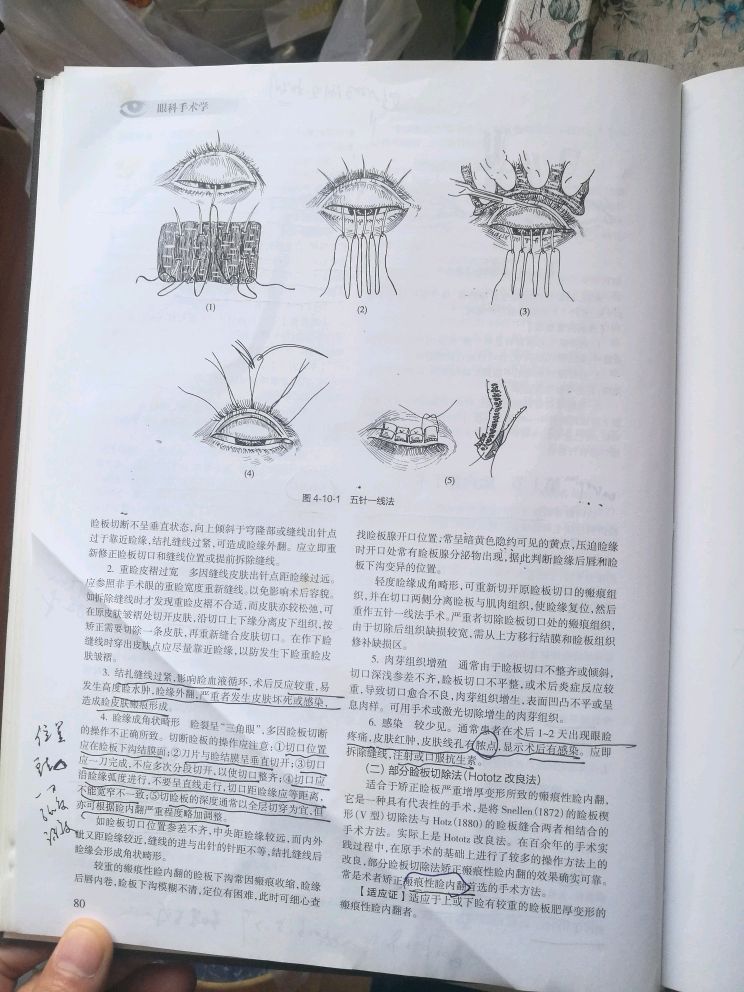 瘢痕性睑内翻,可以考虑的手术方法有 五针一线法,hototz法,睑缘间切开