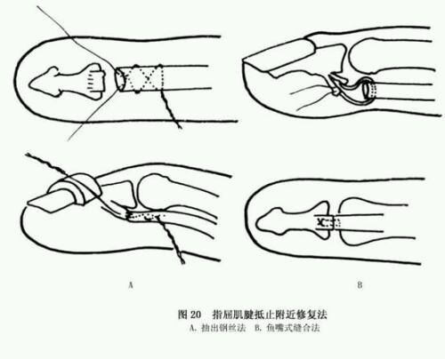 手部肌腱断裂术后康复指导