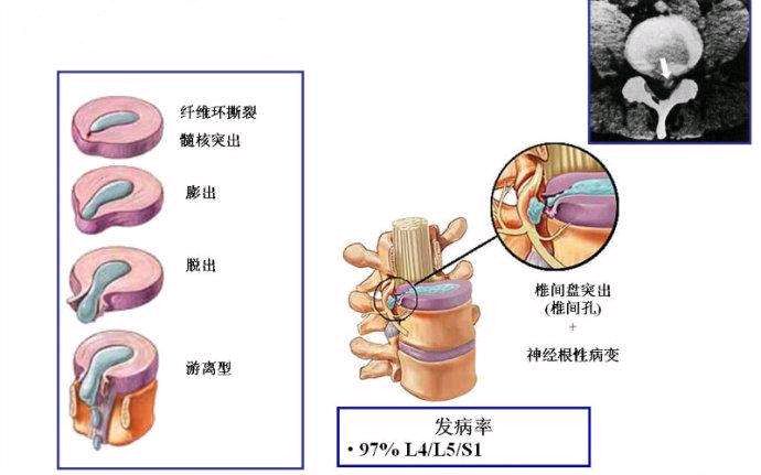 什么是椎间盘突出膨出脱出游离怎样治疗最好