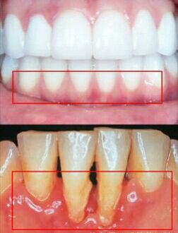 牙周病导致牙齿脱落的重要原因