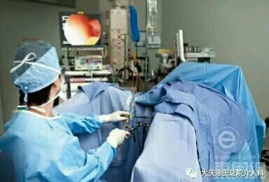 四,微创介入子宫动脉栓塞术: 介入只需要在股动脉穿刺一个2mm大小的