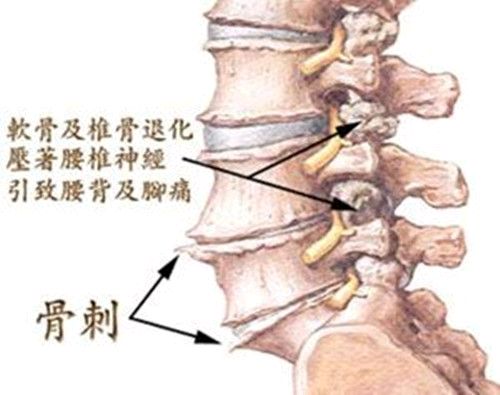 什么是骨刺骨刺是病吗