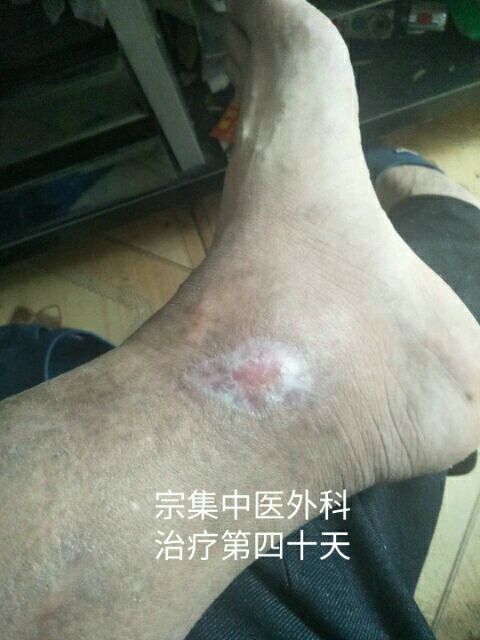 老烂腿