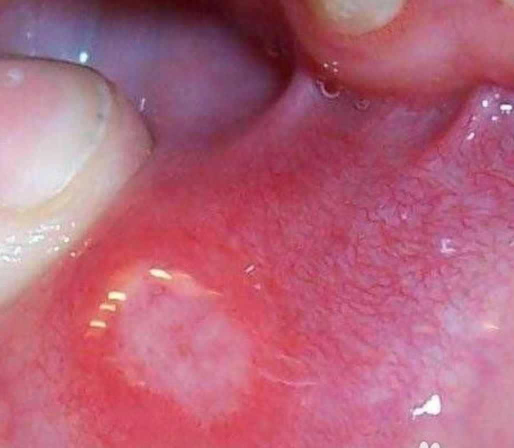 口腔溃疡,是发生在口腔黏膜上的表浅性溃疡,大小不等,小的米粒大小,大