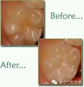 儿童牙齿常识