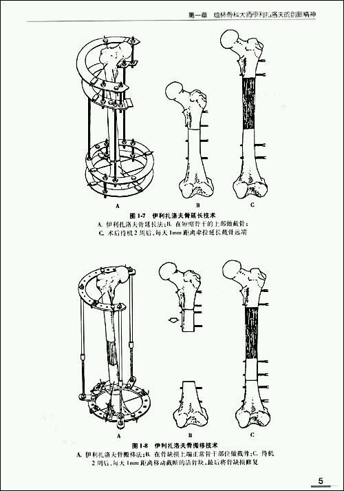 截骨搬移术(肢体延长术)