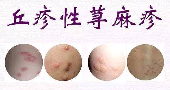 身上出很痒的疙瘩,原来是它们在作怪!